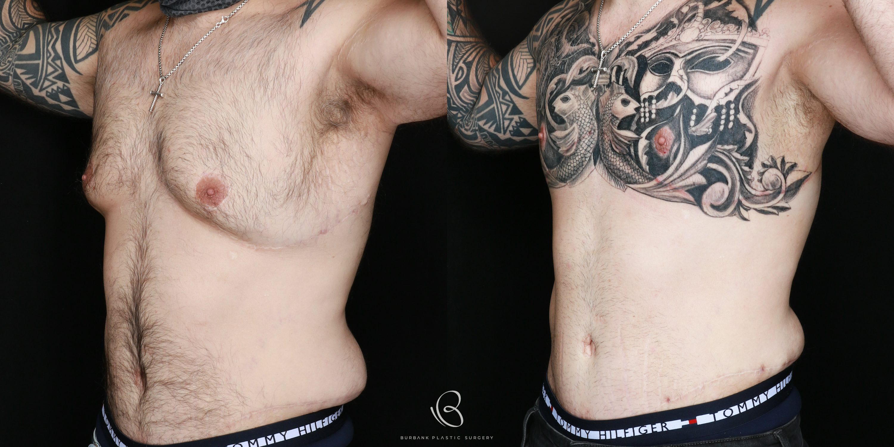 Man Before and After Gynecomastia Left 45 degree View