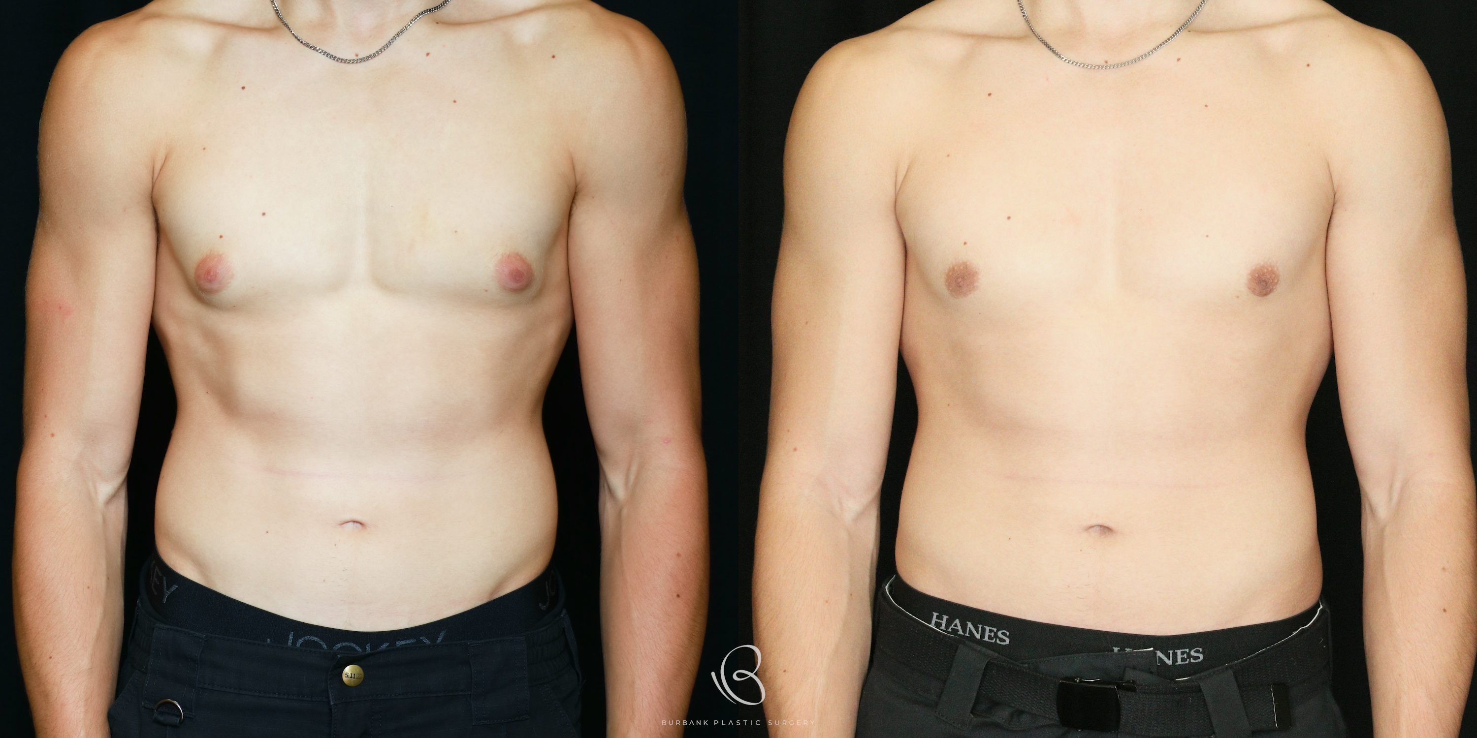 Male Before and After Gynecomastia Front View