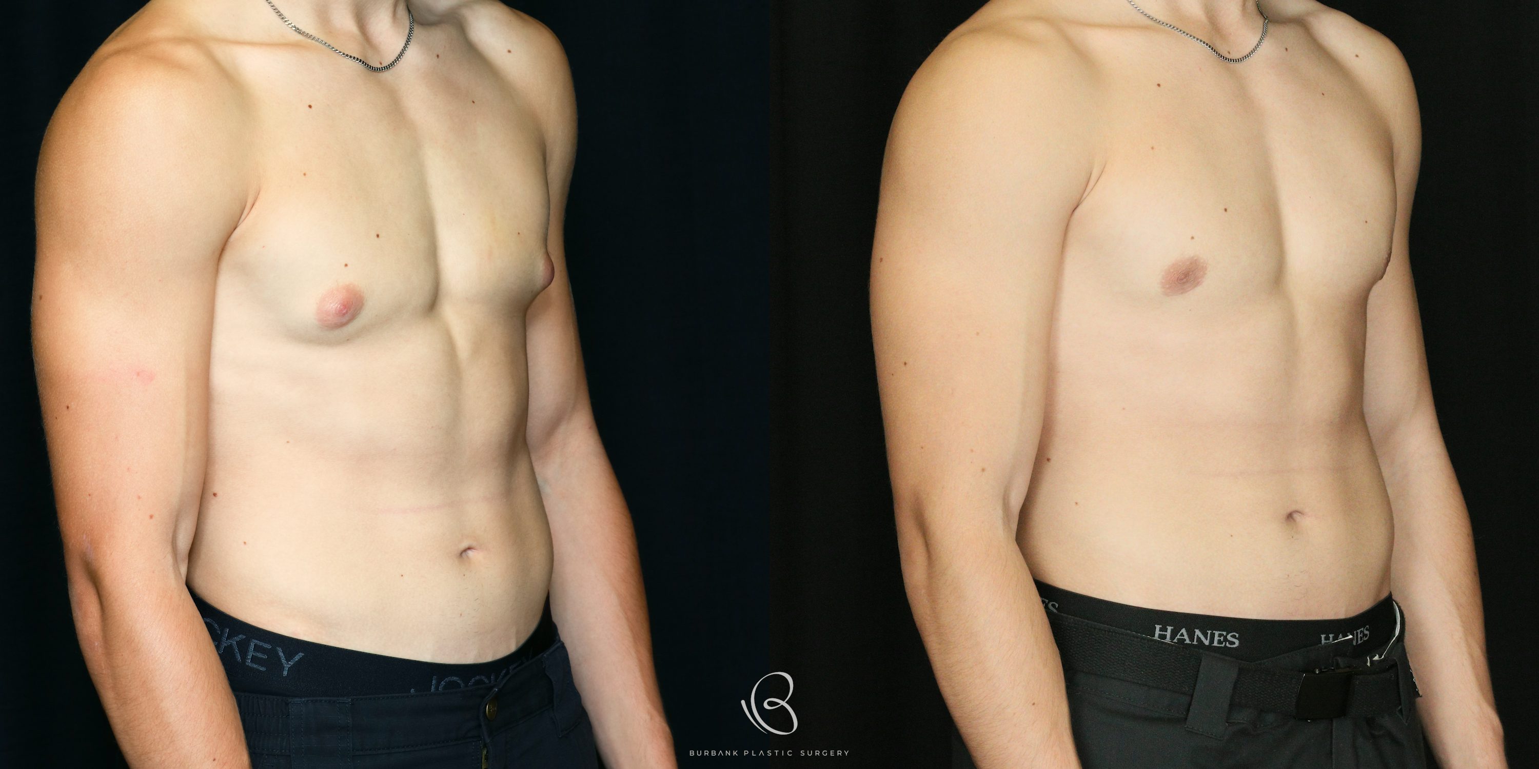 Male Before and After Gynecomastia Right Side 45 Degree View