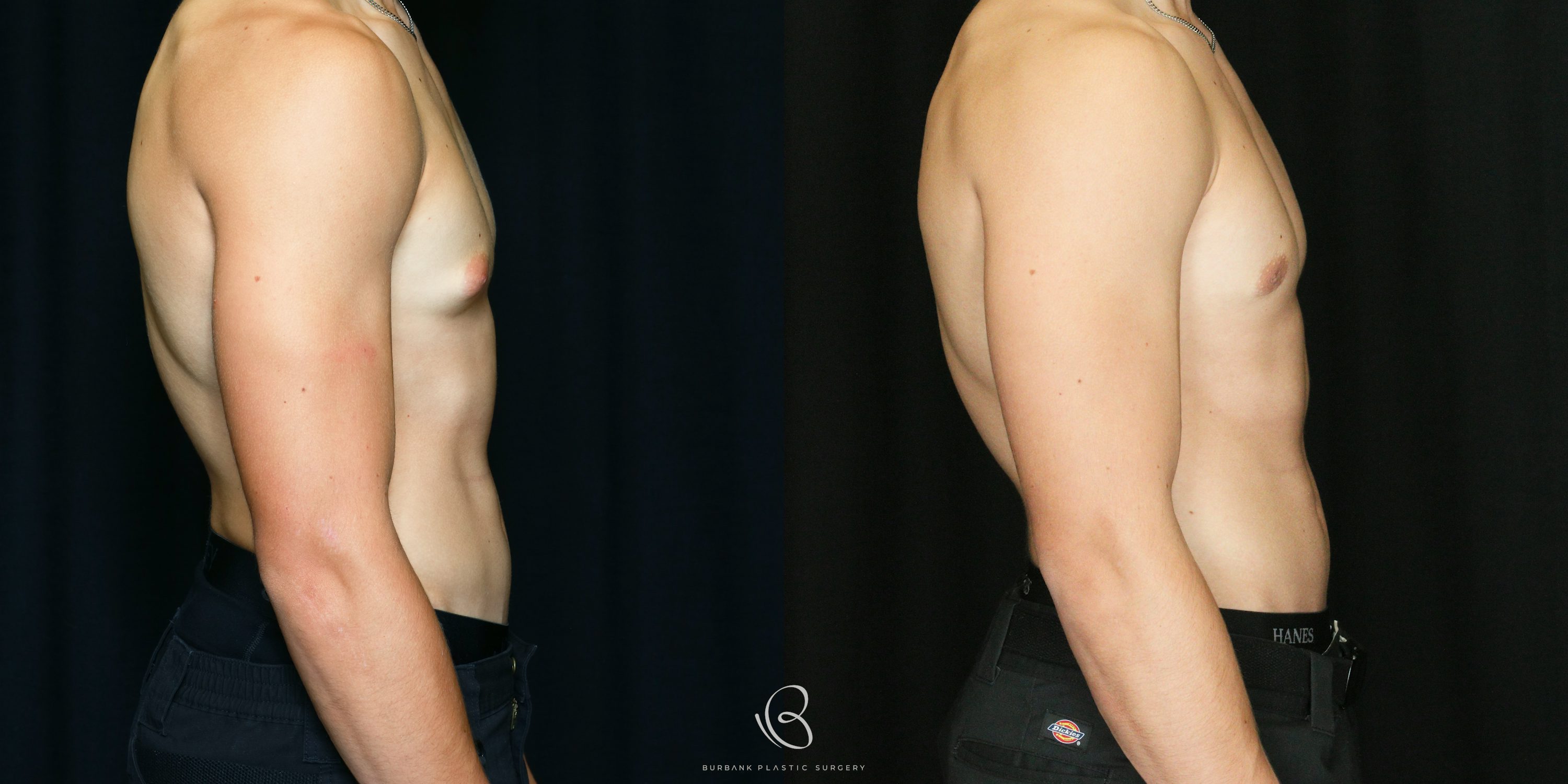 Male Before and After Gynecomastia Right Side View
