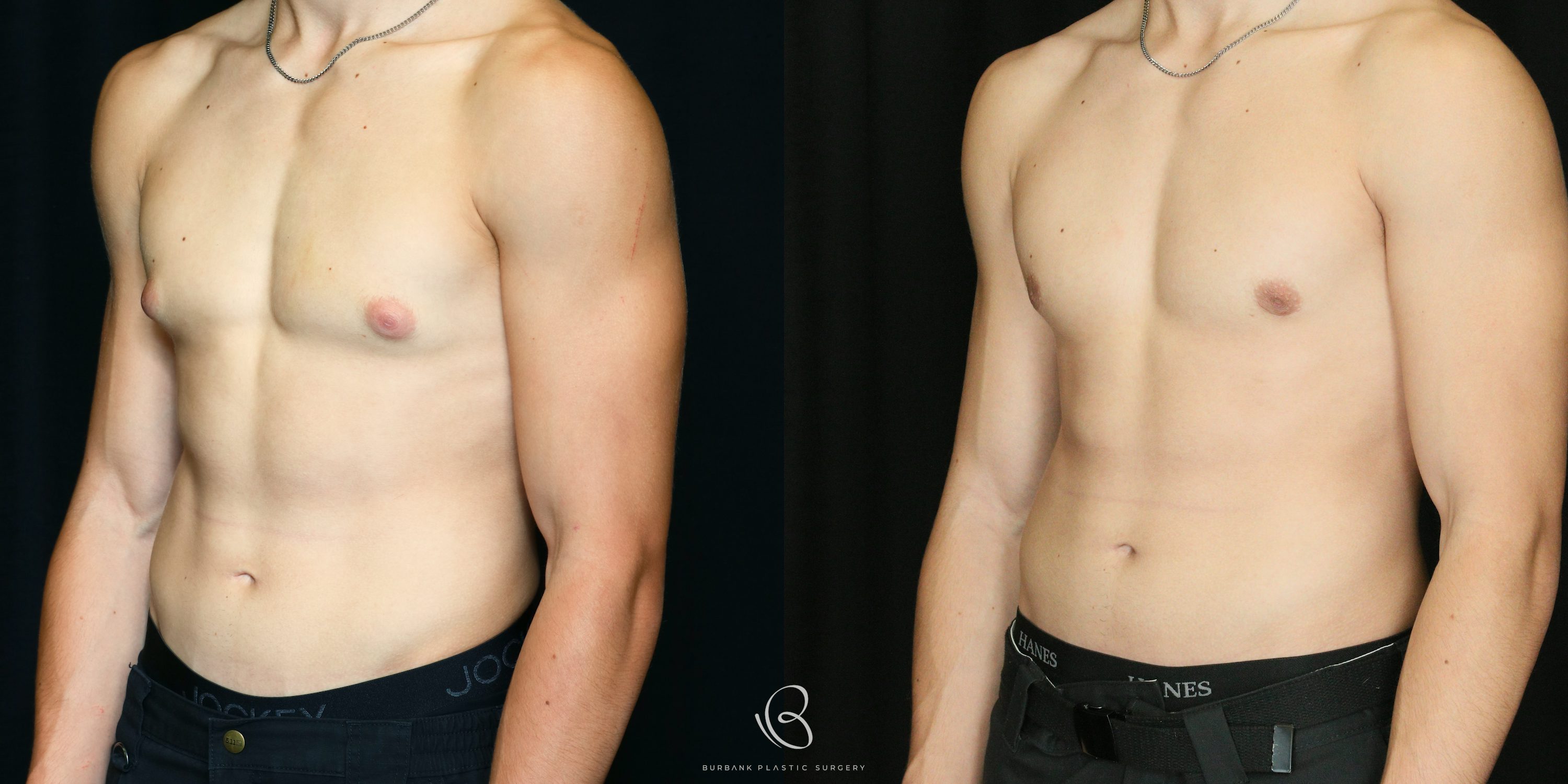 Male Before and After Gynecomastia Left Side 45 degree View