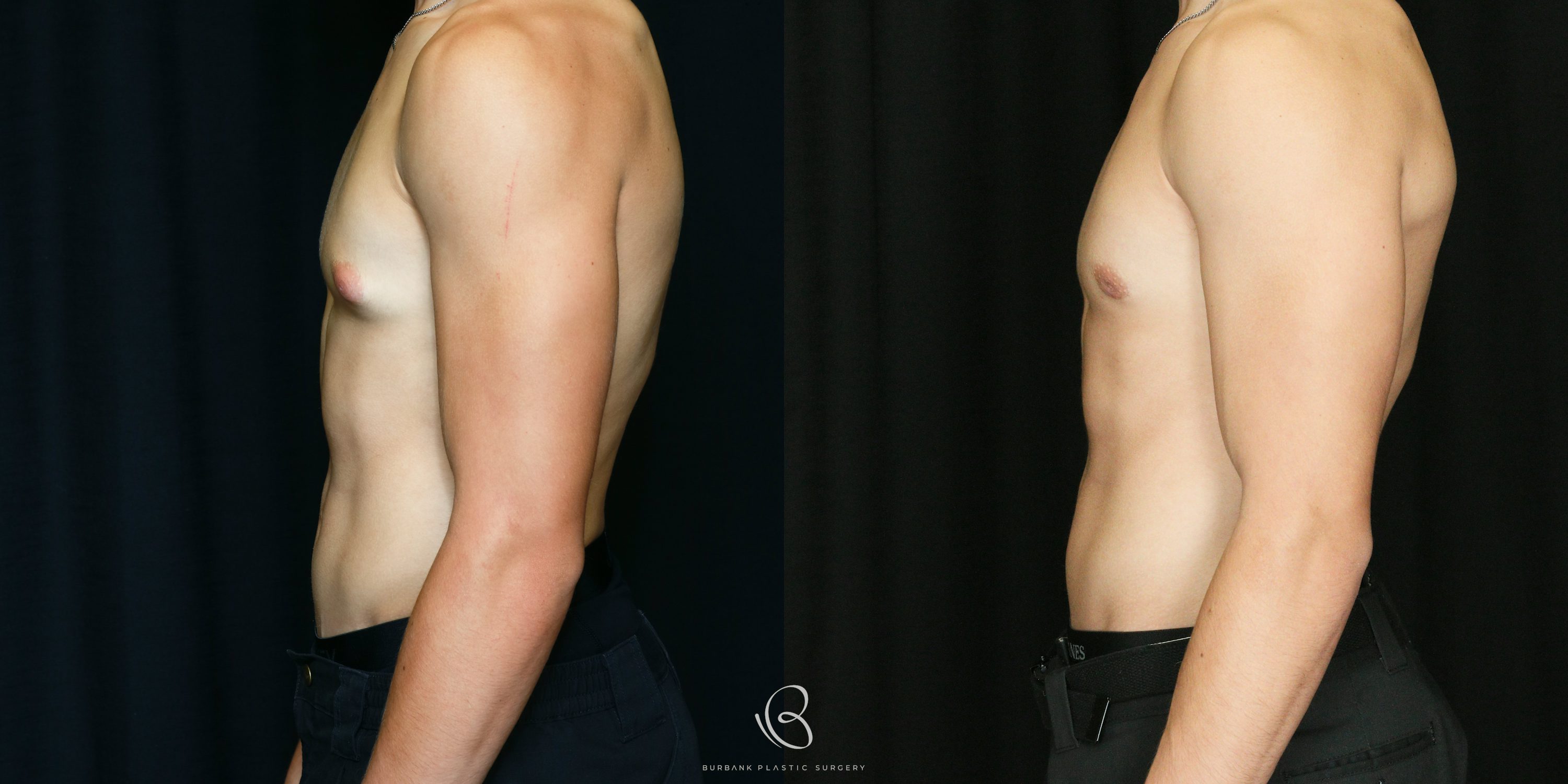 Male Before and After Gynecomastia Left Side View