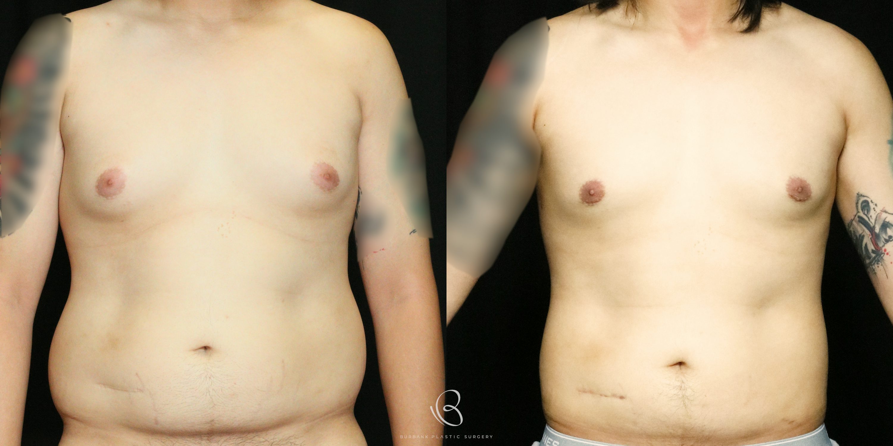 Male Before and After Gynecomastia Front View