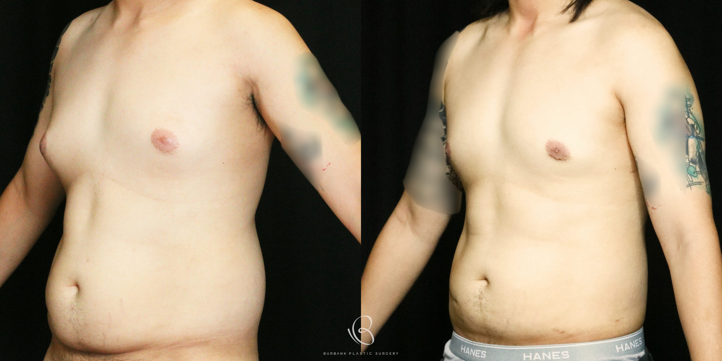 Male Before and After Gynecomastia Left Side 45 Degree View