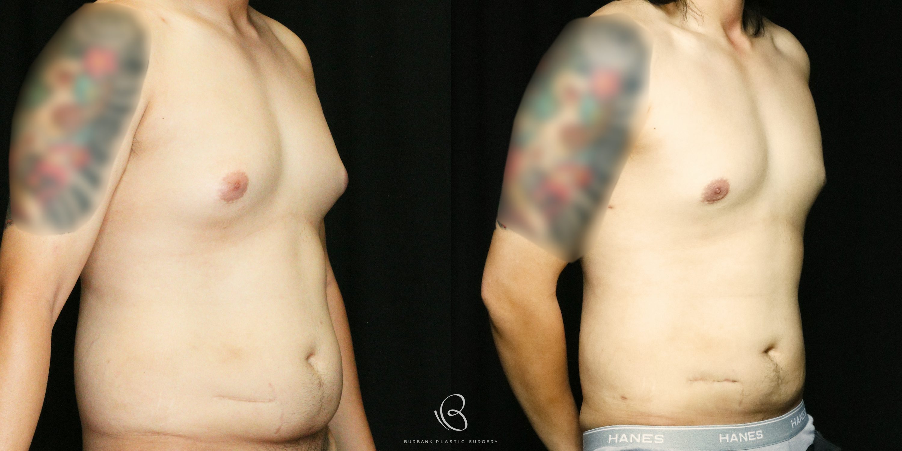Male Before and After Gynecomastia Right Side 45 Degree  View