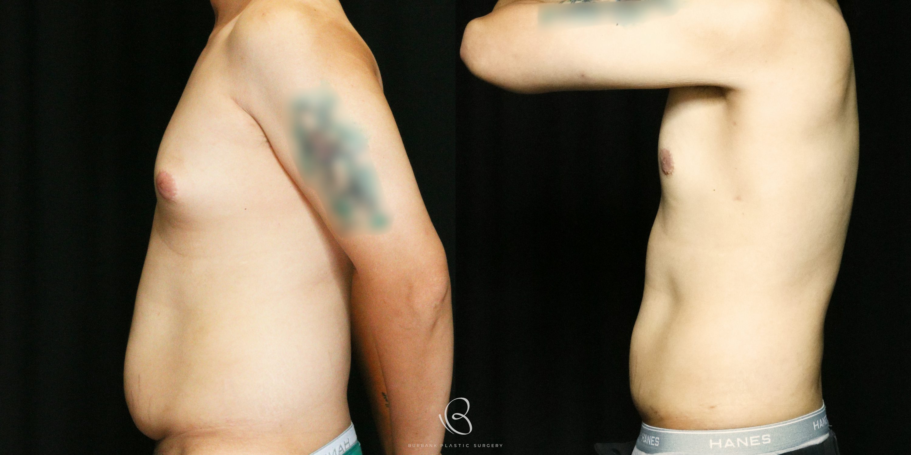 Male Before and After Gynecomastia Left Side View