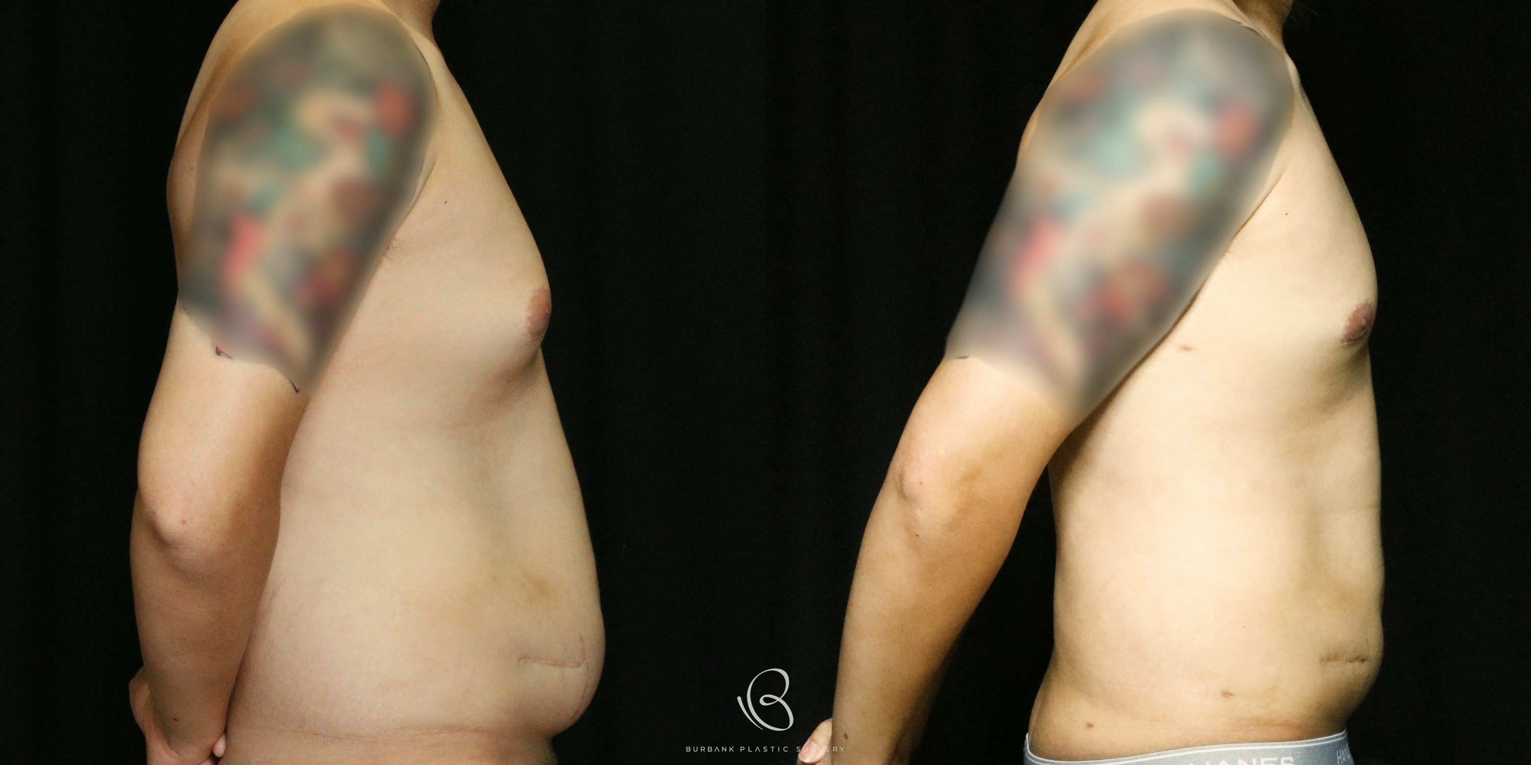 Male Before and After Gynecomastia Right Side  View
