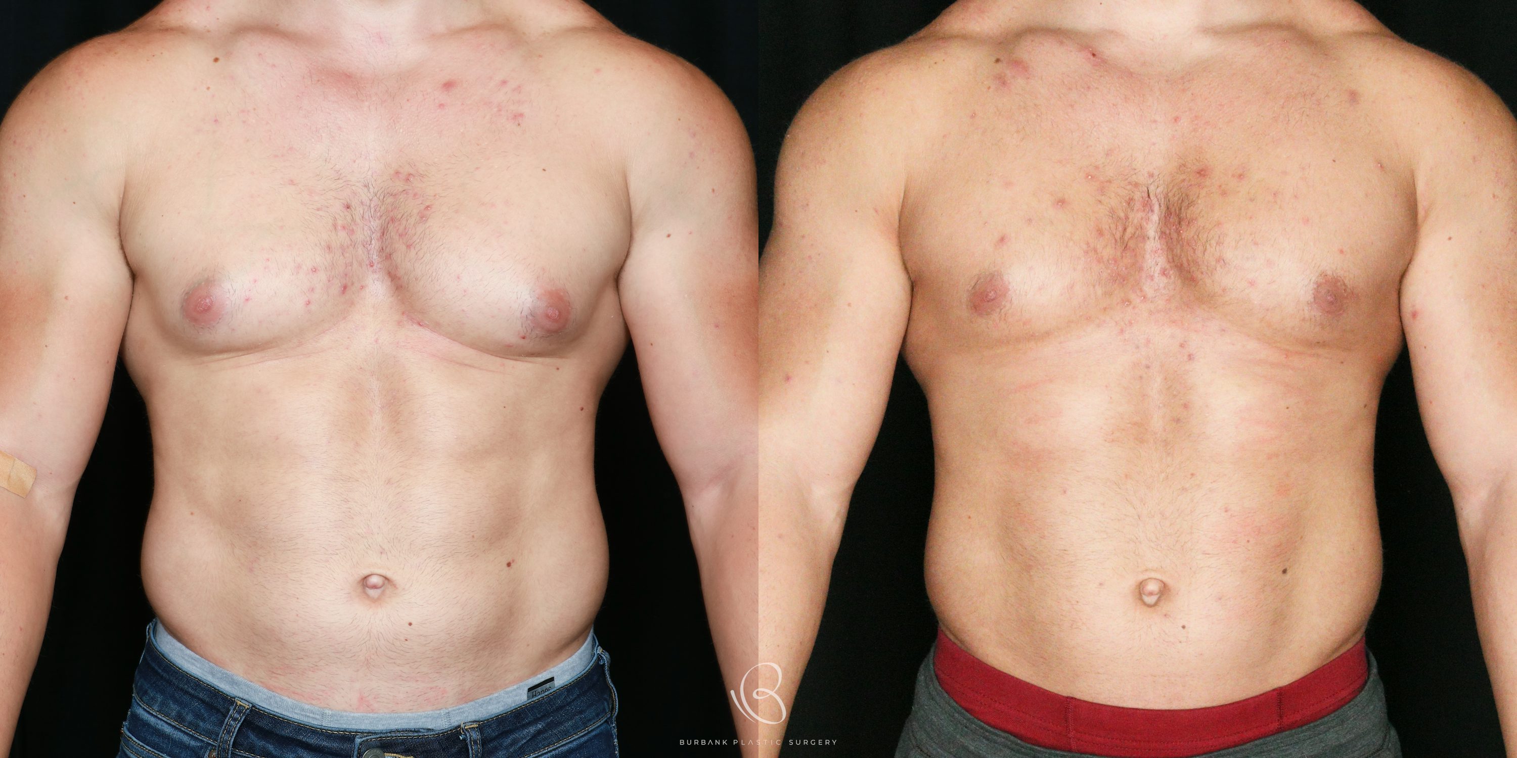 Male Before and After Gynecomastia Front View