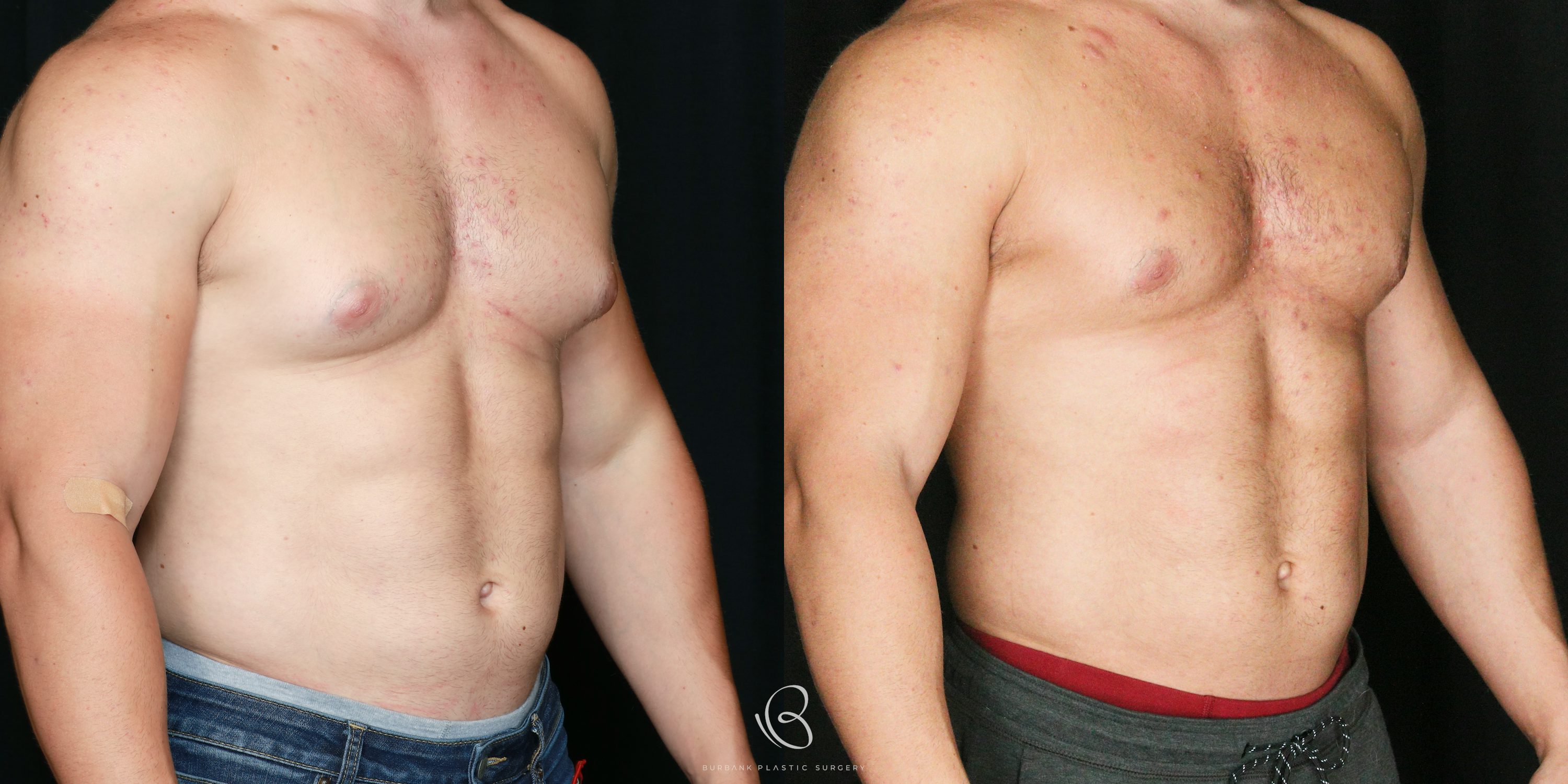 Male Before and After Gynecomastia Right Side 45 Degree View