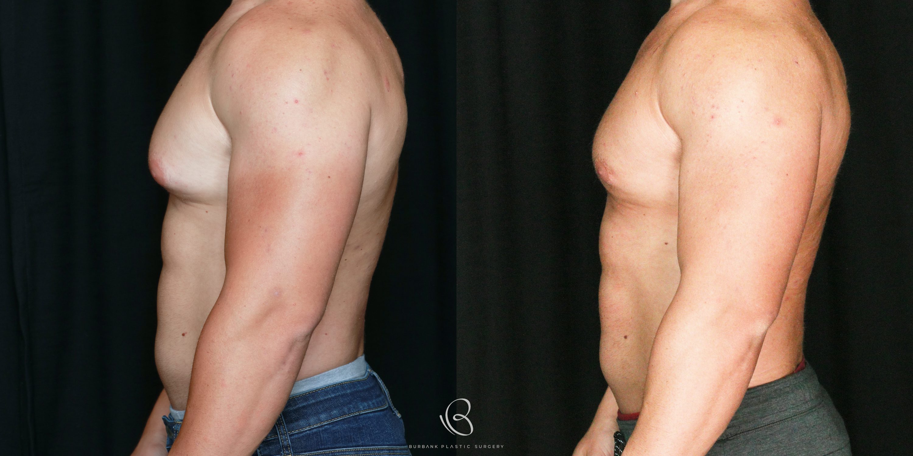 Male Before and After Gynecomastia Left Side View