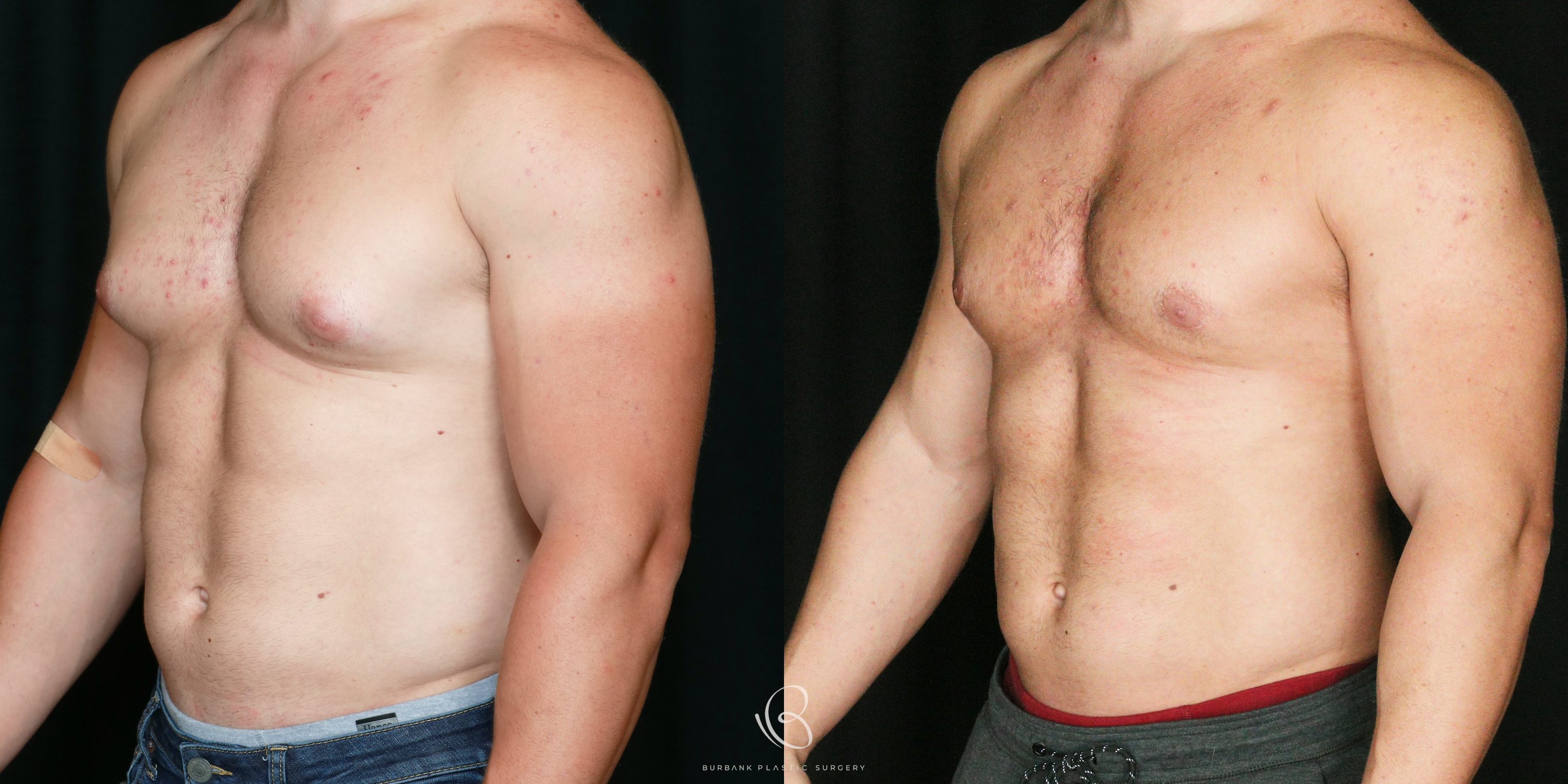 Male Before and After Gynecomastia Left Side 45 Degree View