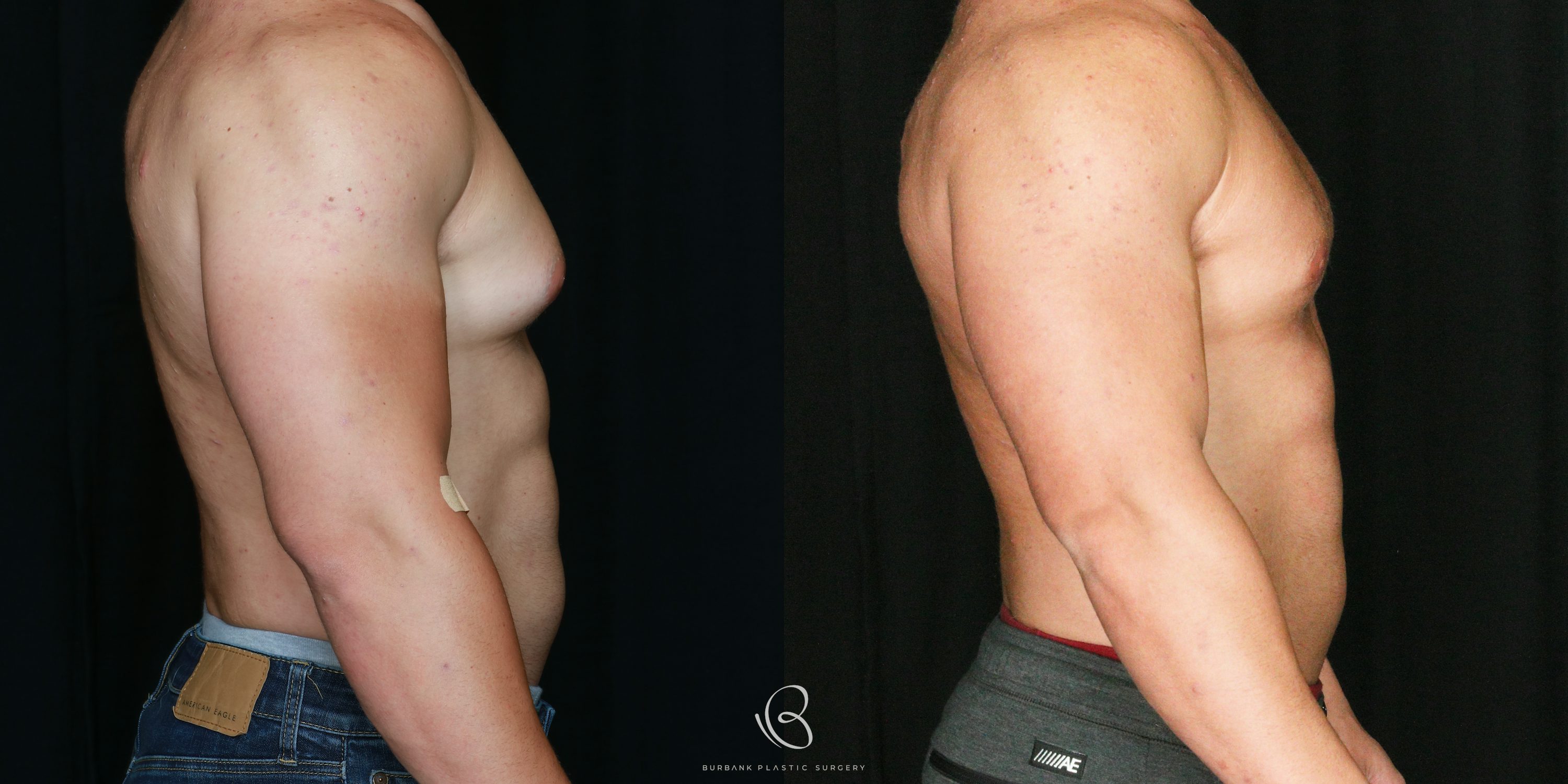 Male Before and After Gynecomastia Right Side View