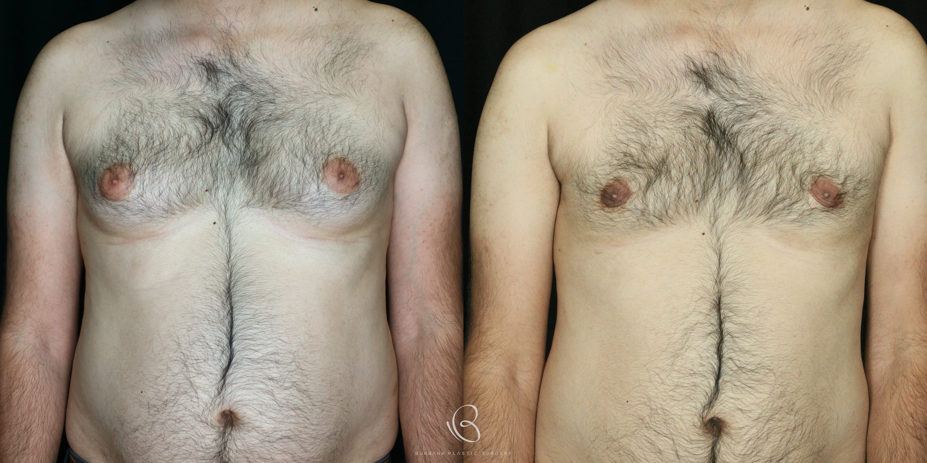 Male Before and After Liposuction of the chest and gynecomastia Front View