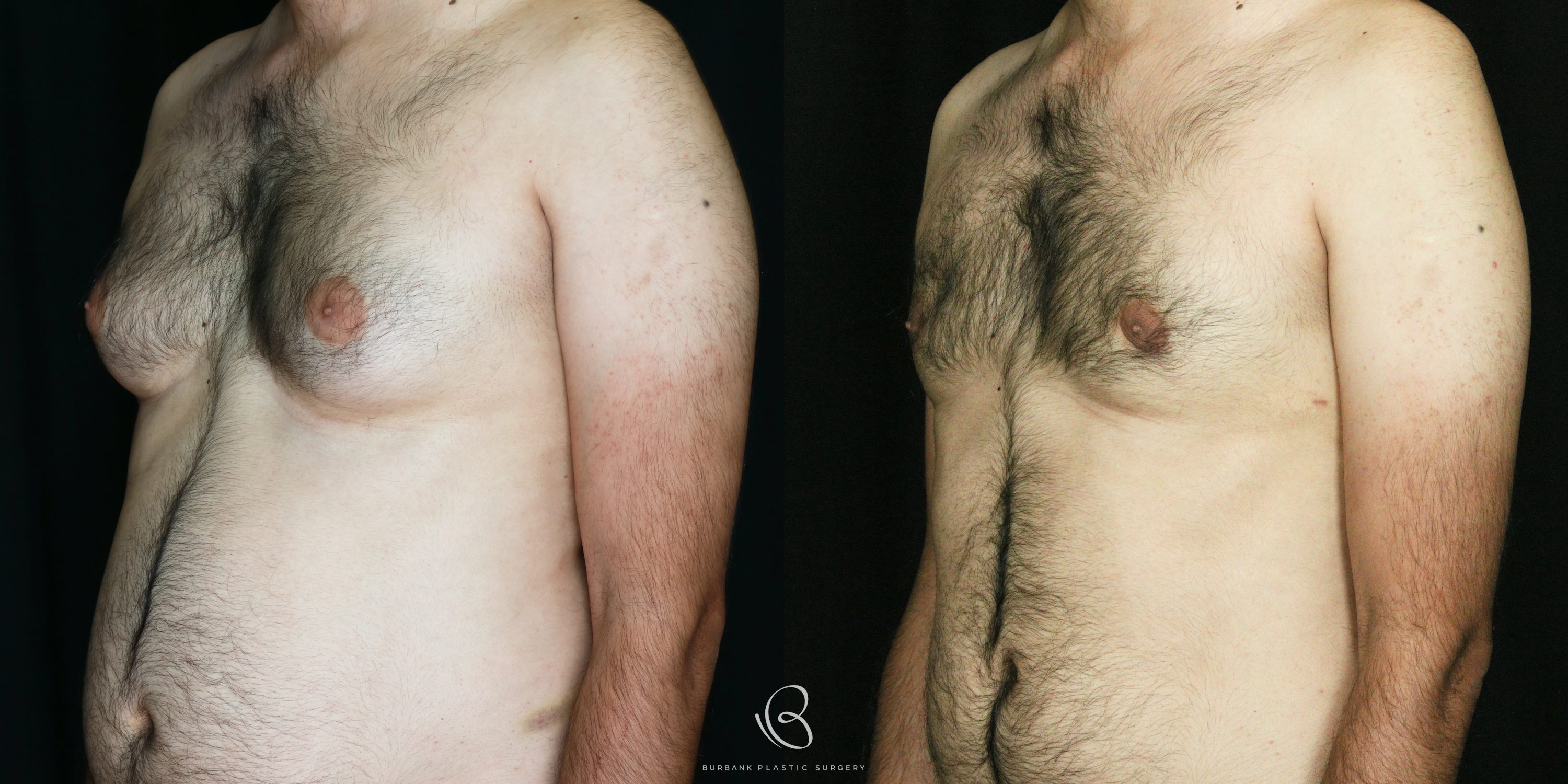 Male Before and After Liposuction of the chest and gynecomastia Left Side 45 Degree View