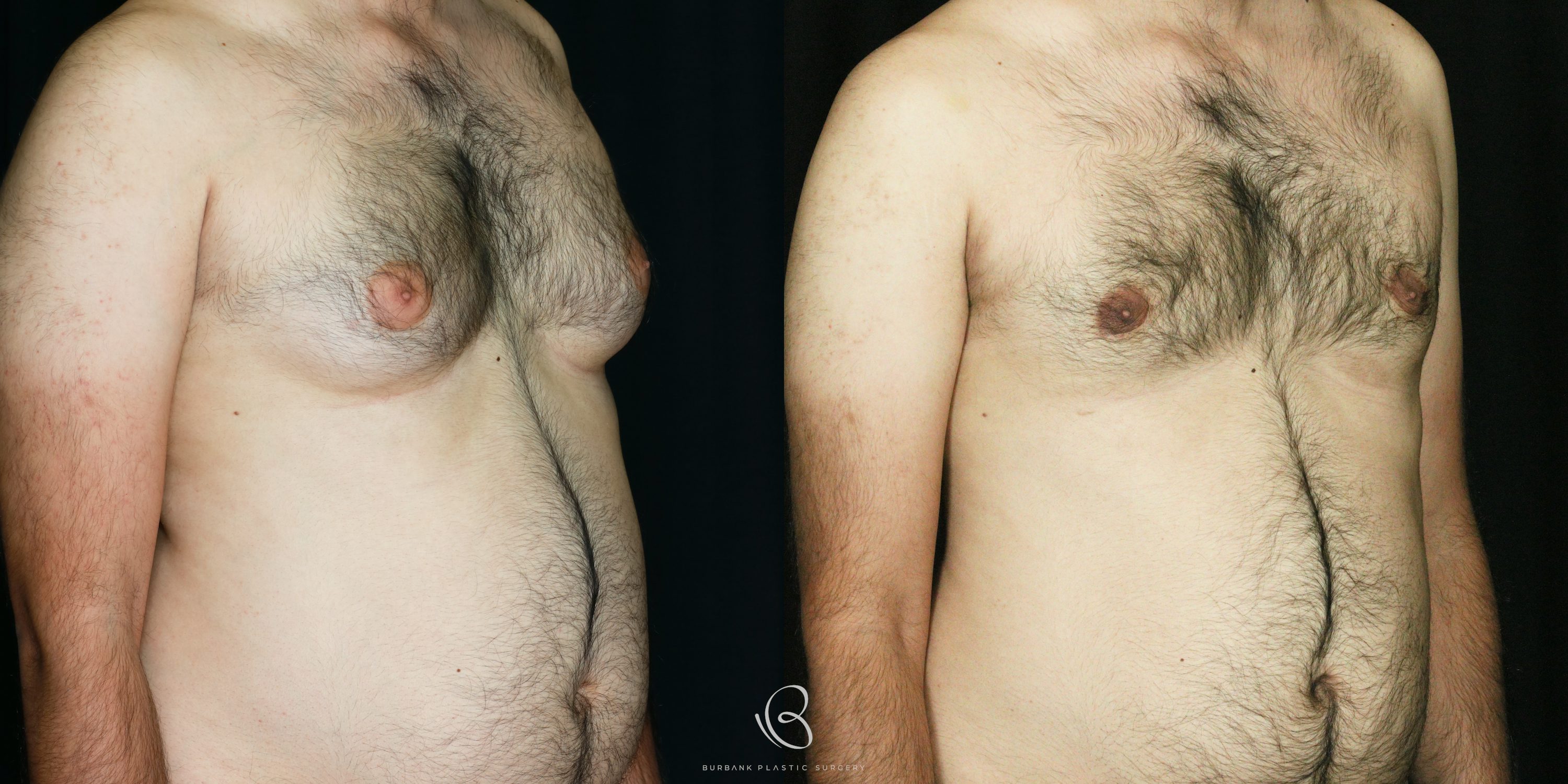 Male Before and After Liposuction of the chest and gynecomastia Right side 45 degree View