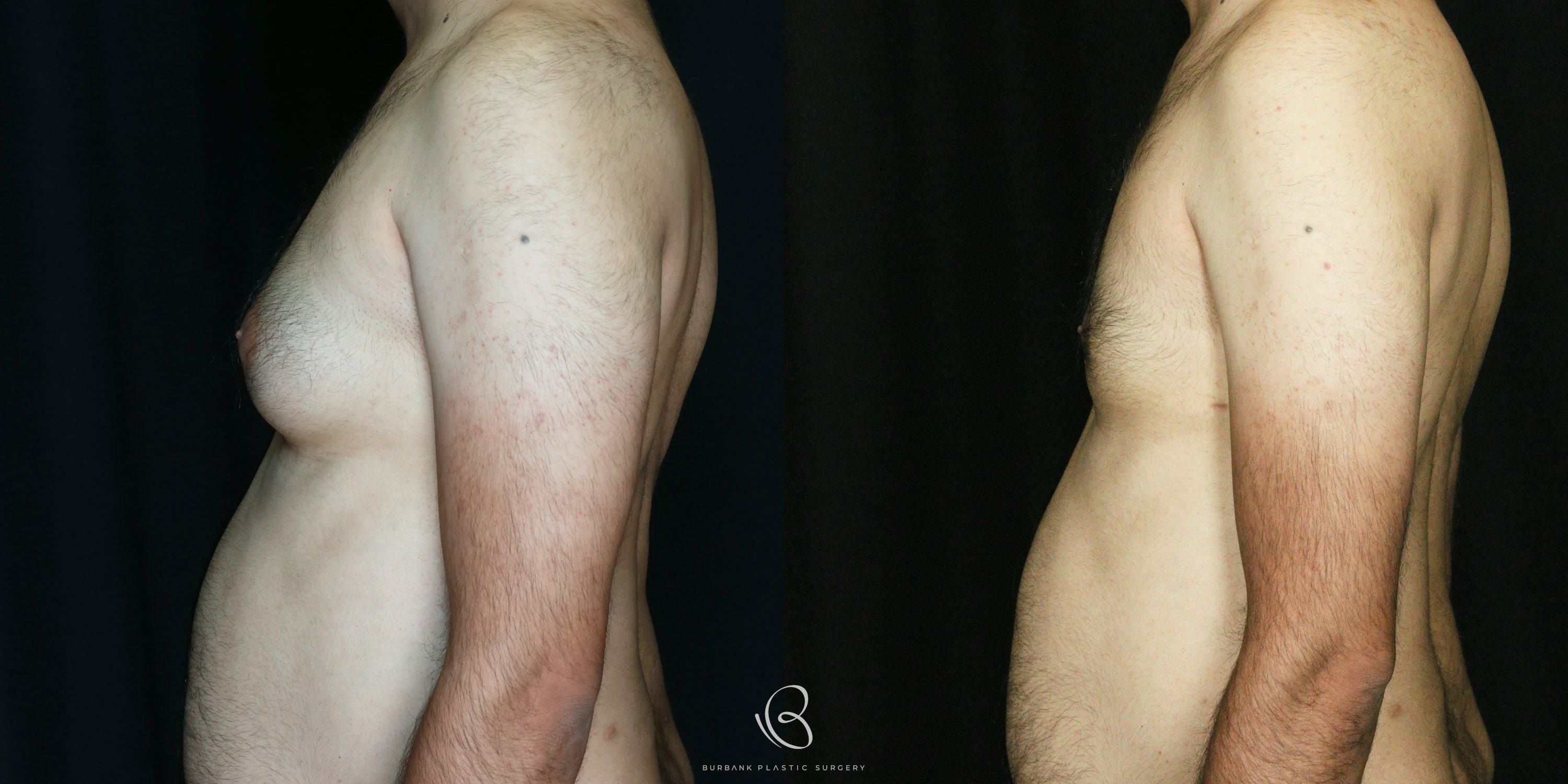 Male Before and After Liposuction of the chest and gynecomastia Left Side  View
