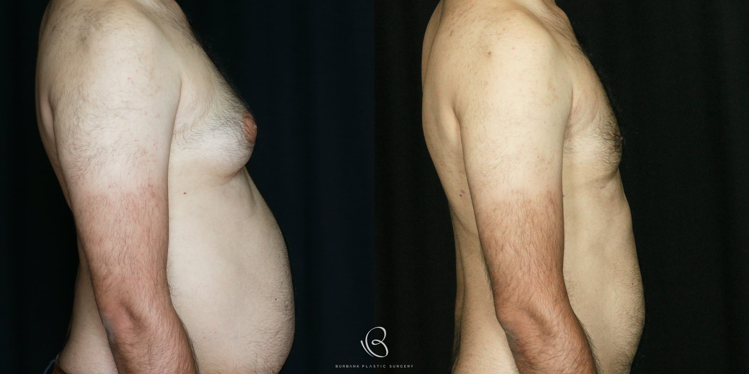 Male Before and After Liposuction of the chest and gynecomastia right side View
