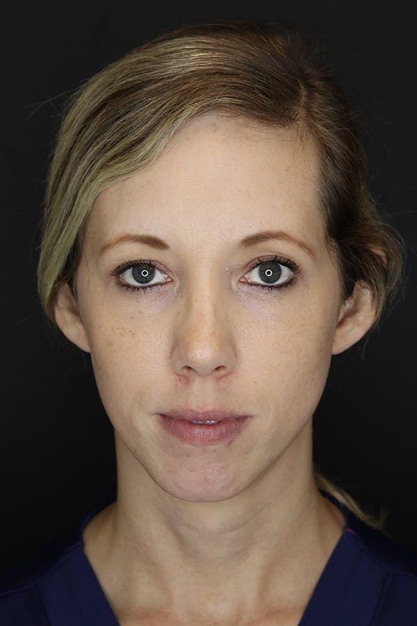 Facial Fillers Before & After Gallery - Patient 53082238 - Image 1