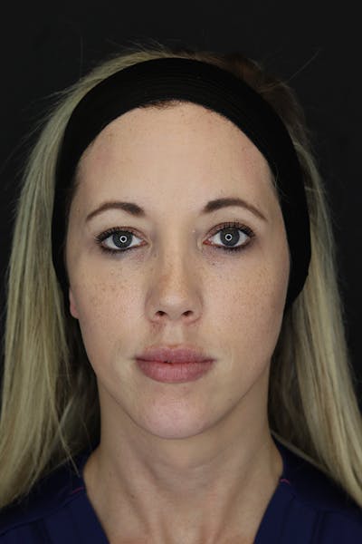 Facial Fillers Before & After Gallery - Patient 53082238 - Image 2