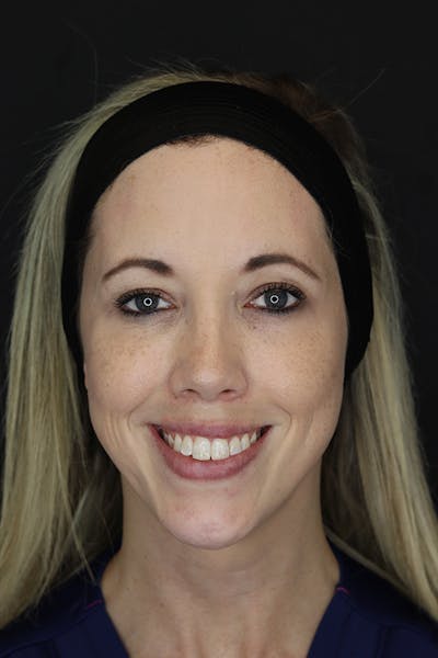 Facial Fillers Before & After Gallery - Patient 53082238 - Image 4
