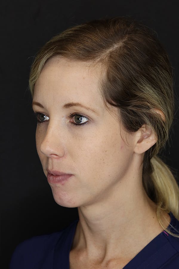 Facial Fillers Before & After Gallery - Patient 53082238 - Image 5