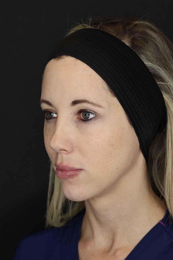 Facial Fillers Before & After Gallery - Patient 53082238 - Image 6