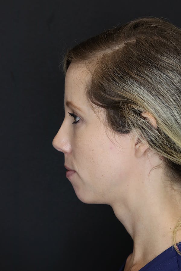 Facial Fillers Before & After Gallery - Patient 53082238 - Image 7