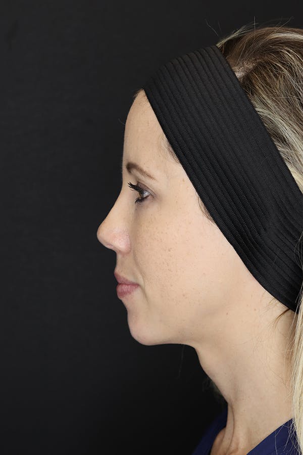 Facial Fillers Before & After Gallery - Patient 53082238 - Image 8