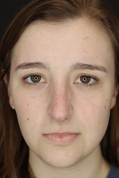 Rhinoplasty Before & After Gallery - Patient 53084382 - Image 1