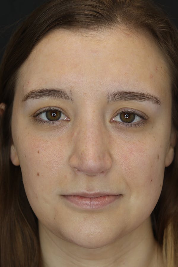 Rhinoplasty Before & After Gallery - Patient 53084382 - Image 2