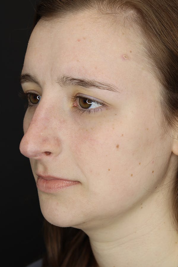 Rhinoplasty Before & After Gallery - Patient 53084382 - Image 3