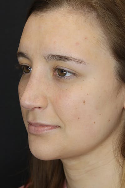 Rhinoplasty Before & After Gallery - Patient 53084382 - Image 4