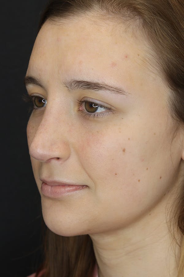 Rhinoplasty Before & After Gallery - Patient 53084382 - Image 4