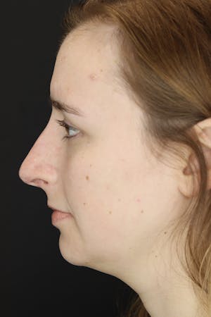 Before and after face and neck liposuction