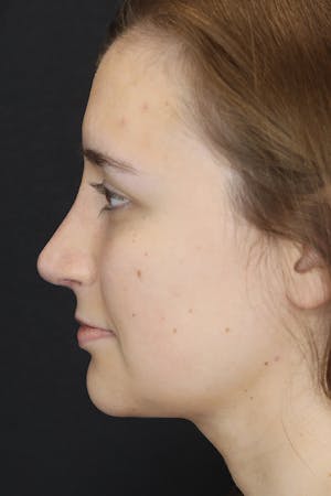 Before and after face and neck liposuction