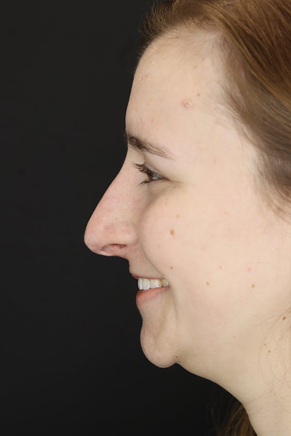 Rhinoplasty Before & After Gallery - Patient 53084382 - Image 7