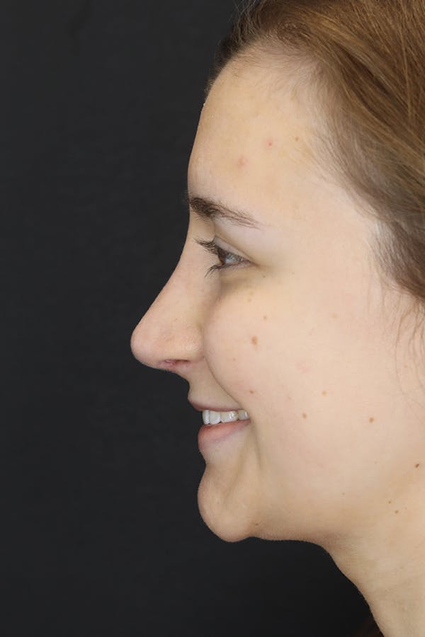 Rhinoplasty Before & After Gallery - Patient 53084382 - Image 8