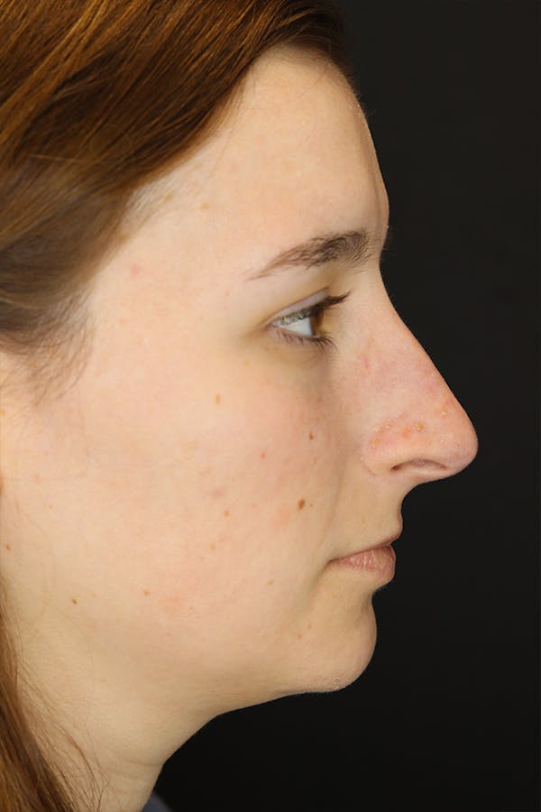 Rhinoplasty Before & After Gallery - Patient 53084382 - Image 9