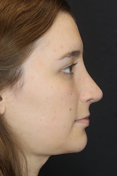 Facial Fillers Before & After Gallery - Patient 53082239 - Image 10