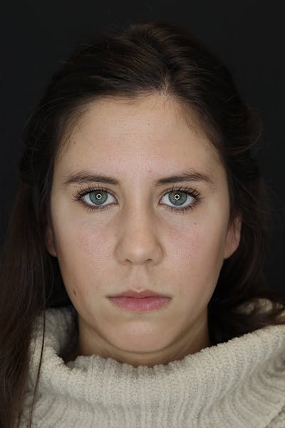 Facial Fillers Before & After Gallery - Patient 53082240 - Image 1