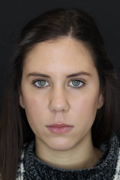 Facial Fillers Before & After Gallery - Patient 53082240 - Image 2
