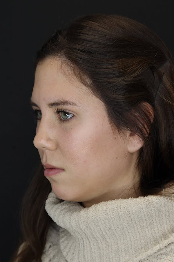 Facial Fillers Before & After Gallery - Patient 53082240 - Image 3