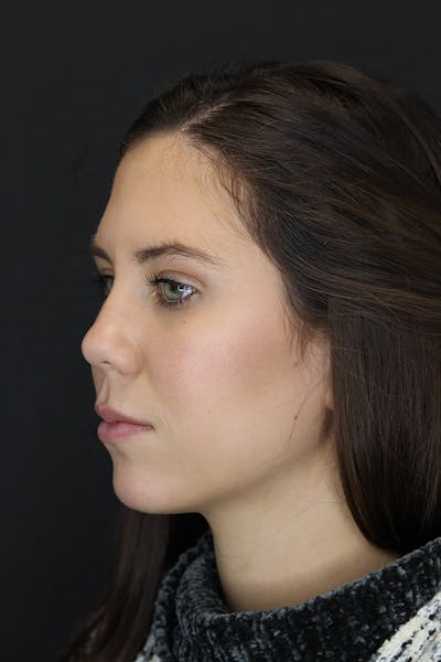 Facial Fillers Before & After Gallery - Patient 53082240 - Image 4
