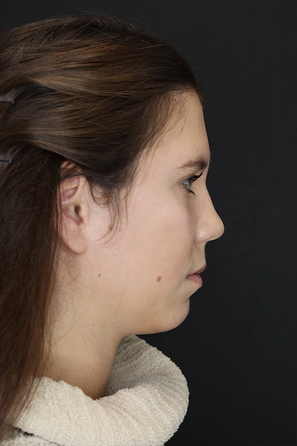 Facial Fillers Before & After Gallery - Patient 53082240 - Image 5