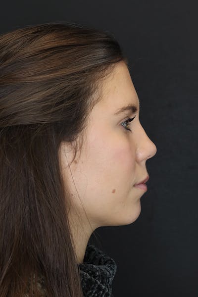 Facial Fillers Before & After Gallery - Patient 53082240 - Image 6