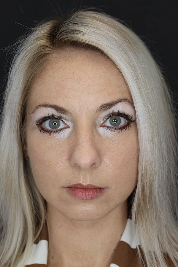 Rhinoplasty Before & After Gallery - Patient 53084380 - Image 1