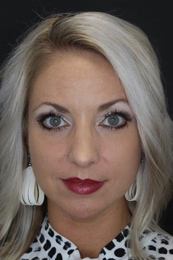 Rhinoplasty Before & After Gallery - Patient 53084380 - Image 2