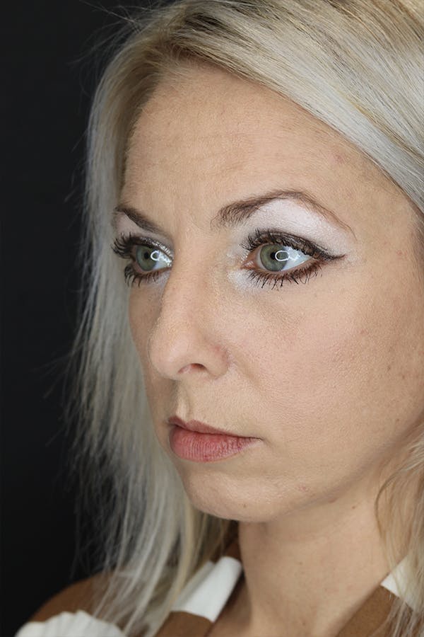 Rhinoplasty Before & After Gallery - Patient 53084380 - Image 3