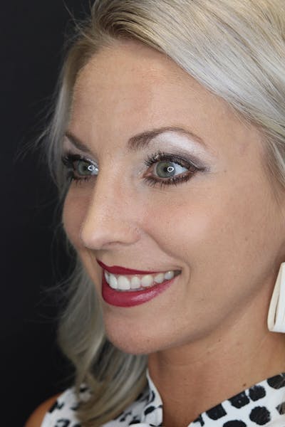 Rhinoplasty Before & After Gallery - Patient 53084380 - Image 4