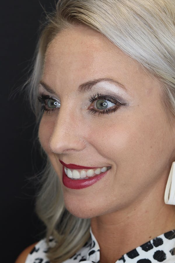Rhinoplasty Before & After Gallery - Patient 53084380 - Image 4